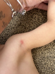 Is this chicken pox?