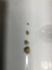 Tonsil Stones… Help! (Warning, gross images)