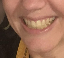 Yellow teeth