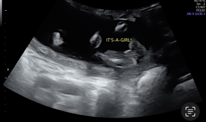 Gender scan at 15W6D accuracy?