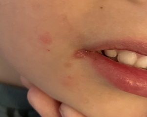 What is this? Cold sore/HFM/impetigo?