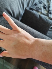 Skin stain after iron infusion