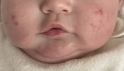 Baby acne in 6 month old