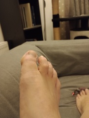 Lump on big toe (includes toe pics)