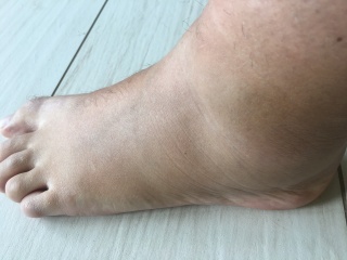 Does this look like a bad sprain to you?