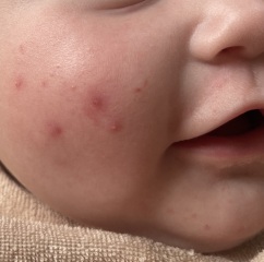 Infantile acne