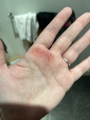 Weird bruise on hand ?!
