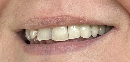 Permanent crown looks worse that temporary