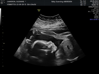 Pregnant after miscarriage - support thread NEW