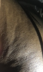 Dent/dimple in boob .. anyone pls