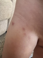 Is this chicken pox?