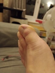 Lump on big toe (includes toe pics)