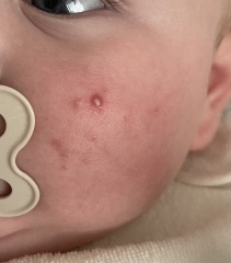 Baby acne in 6 month old