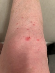 What is this rash?