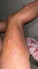Anyone please help itchy patches on leg