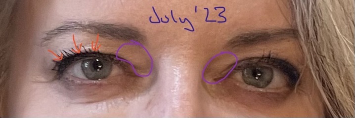 Upper Blepheroplasty