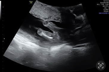 Gender scan at 15W6D accuracy?