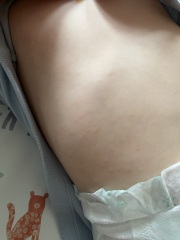 Rash, any ideas?