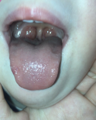 (Pic of inside mouth) These aren’t normal tonsils are they? (2 y/o DD)
