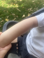 Toddler white rash
