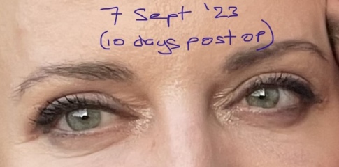 Upper Blepheroplasty