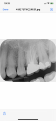 Extraction on nhs or root canal treatment but nhs won’t do it