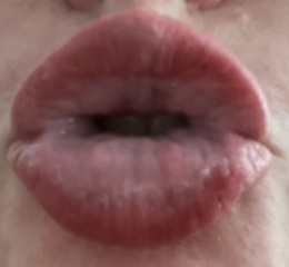 Anyone had this reaction before? *pics*