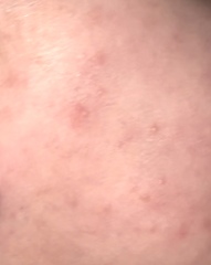 Rash!