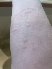 what is this rash/bites/reaction? pic