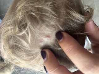 Is this chicken pox?