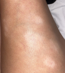 Anyone please help itchy patches on leg