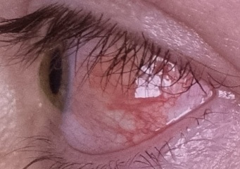 Red Eye (With Picture!)