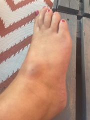 Should I go to minor injuries (photo)