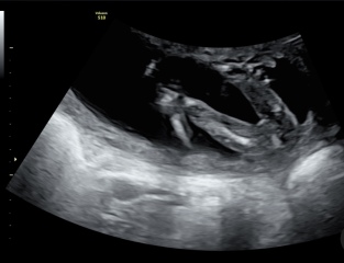 Gender scan at 15W6D accuracy?