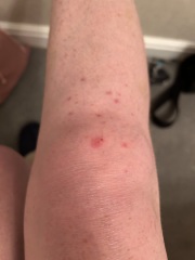 What is this rash?