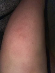 Bites
