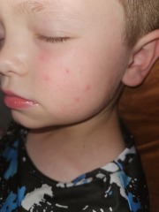 Spots of childs cheek
