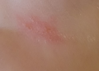 Impetigo or scratch? (Pics)
