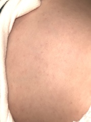 Rash!