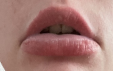 Anyone had this reaction before? *pics*