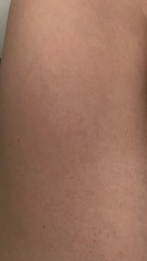 Petechiae rash?