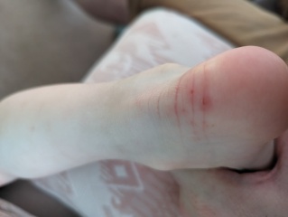 Eczema or something else?