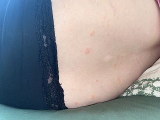 skin rash