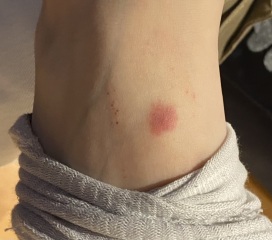 Another rash/bite picture