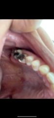 Extraction on nhs or root canal treatment but nhs won’t do it
