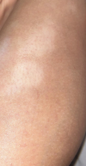 Anyone please help itchy patches on leg