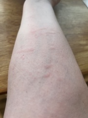 what is this rash/bites/reaction? pic