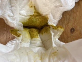 (Pics alert!) Combi fed baby very runny poo / diarrhea