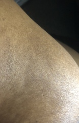 Dent/dimple in boob .. anyone pls