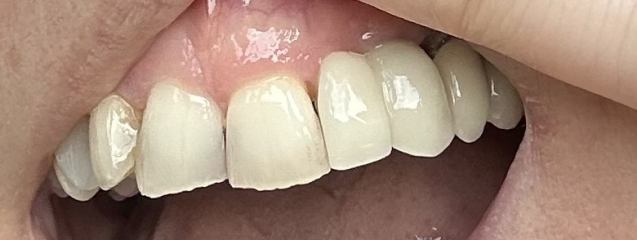 Permanent crown looks worse that temporary